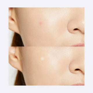 COSRX Acne Pimple Master Patch 24pcs Acne Patches - COSRX -  - JKbeauty